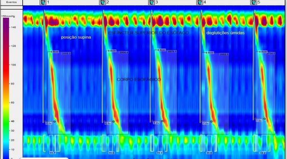 Capacitação em Manometria e pHmetria esofágica de alta resolução no Centro Especializado de Cirurgia Ambulatorial e Endoscópica do Hospital Universitário Lauro Wanderley